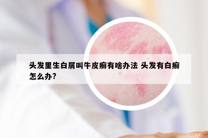 头发里生白屑叫牛皮癣有啥办法 头发有白癣怎么办?