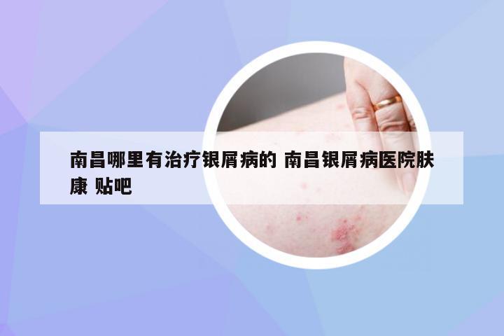 南昌哪里有治疗银屑病的 南昌银屑病医院肤康 贴吧