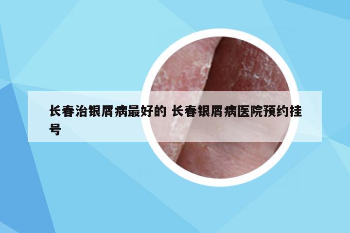 长春治银屑病最好的 长春银屑病医院预约挂号