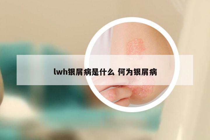 lwh银屑病是什么 何为银屑病