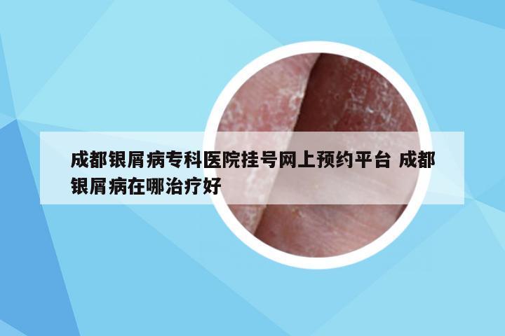 成都银屑病专科医院挂号网上预约平台 成都银屑病在哪治疗好