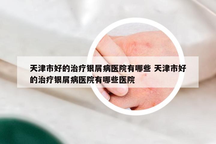 天津市好的治疗银屑病医院有哪些 天津市好的治疗银屑病医院有哪些医院