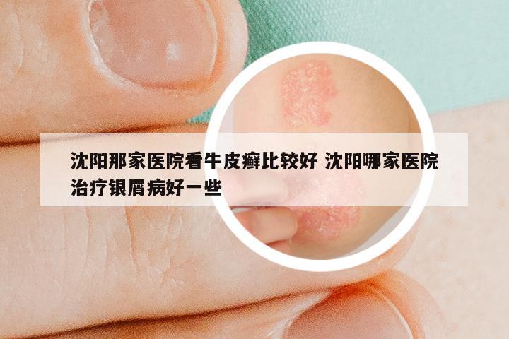 沈阳那家医院看牛皮癣比较好 沈阳哪家医院治疗银屑病好一些