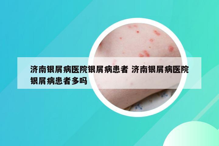 济南银屑病医院银屑病患者 济南银屑病医院银屑病患者多吗