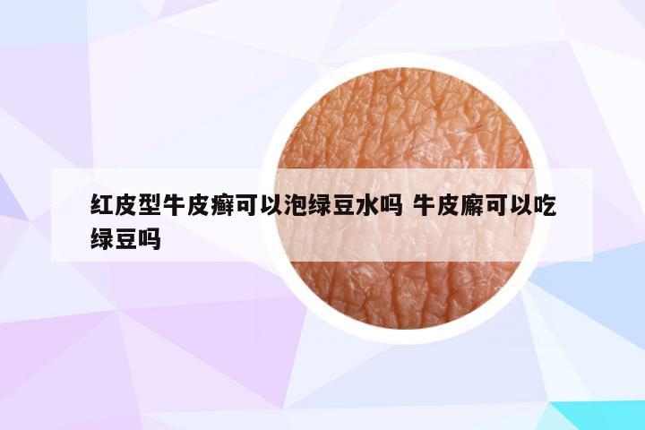 红皮型牛皮癣可以泡绿豆水吗 牛皮廨可以吃绿豆吗