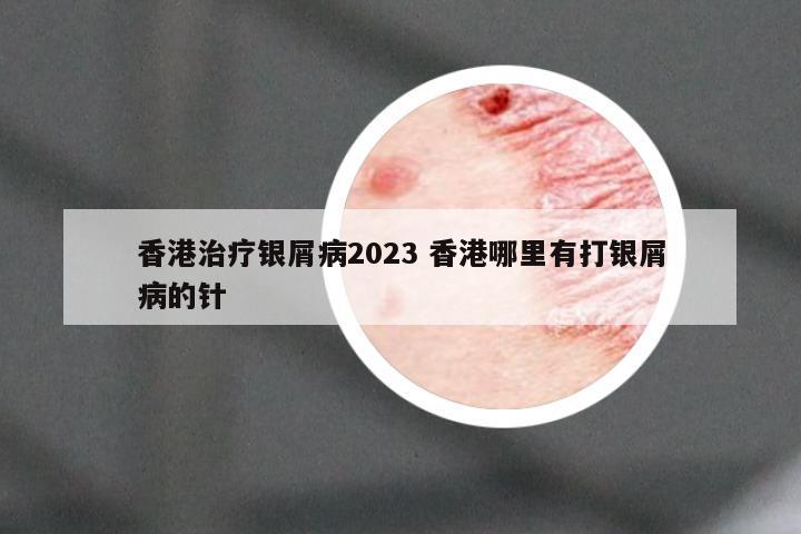 香港治疗银屑病2023 香港哪里有打银屑病的针